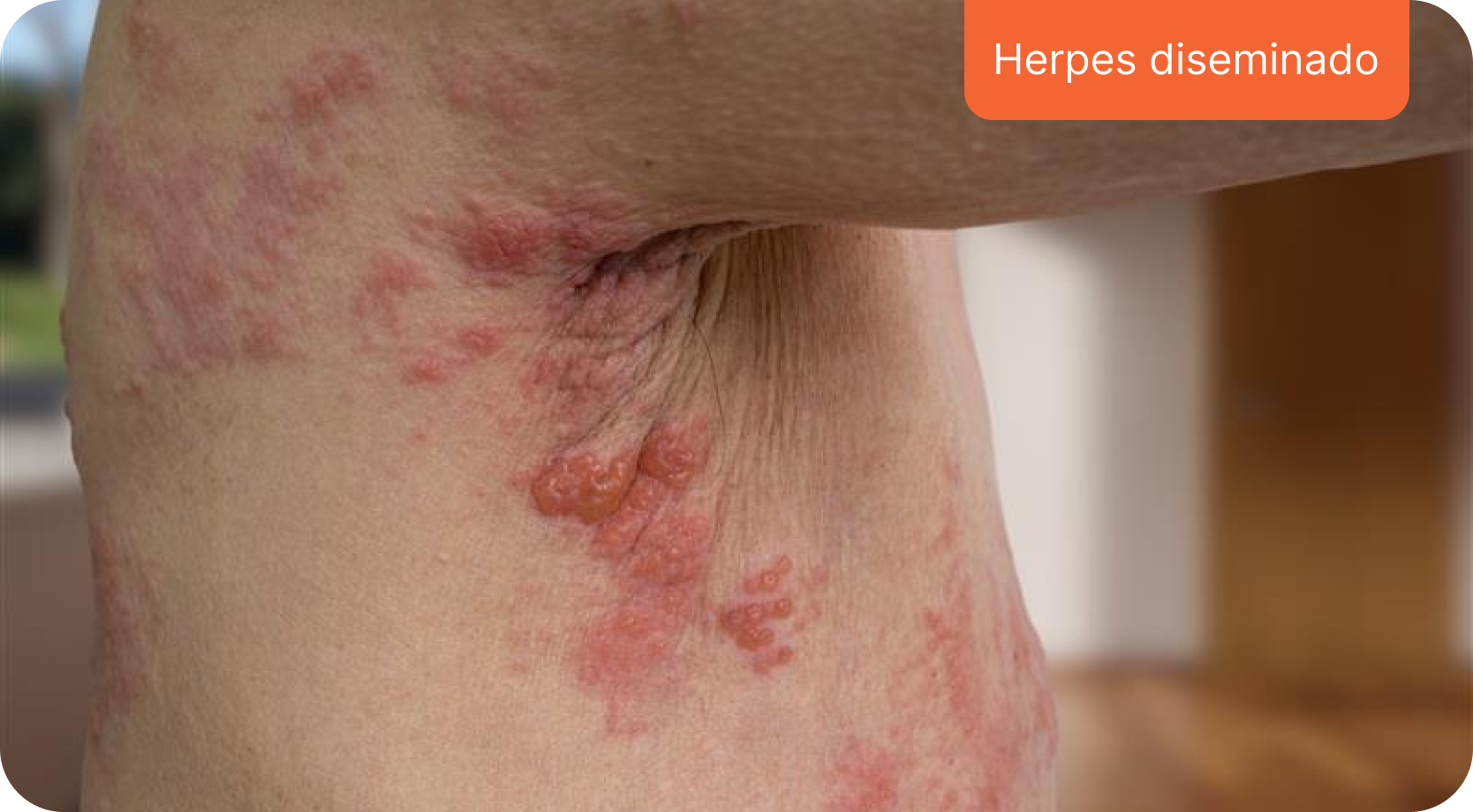 Herpes diseminado