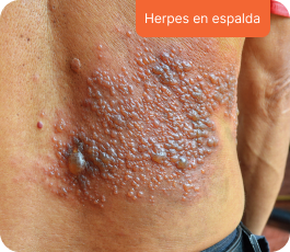 Herpes en espalda