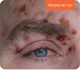 Herpes en ojo