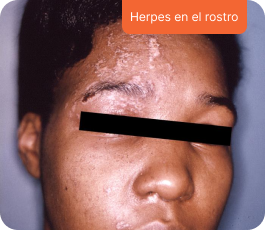 Herpes en el rostro